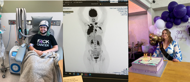 Hayley was diagnosed with stage two Hodgkin’s lymphoma at the age of 26 and went onto beat cancer