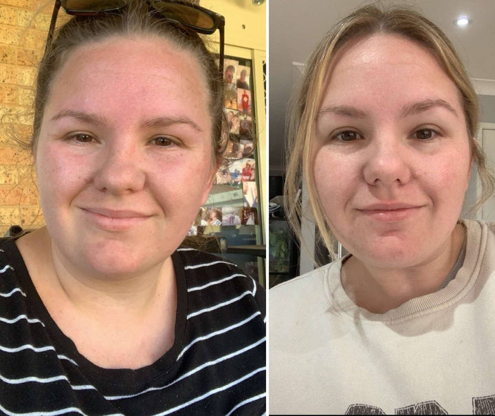 Angie has noticed her face is less swollen in just a few weeks!