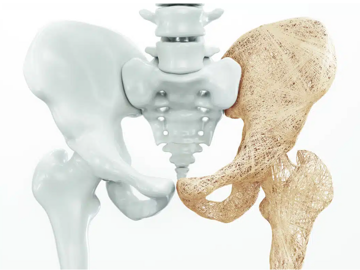 How to Regain Bone Density Naturally