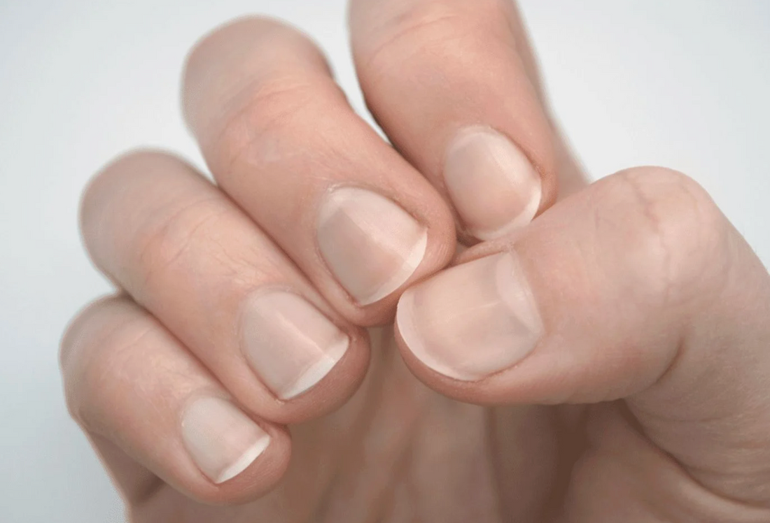 Are Your Nails Trying to Tell You Something About Your Bones?