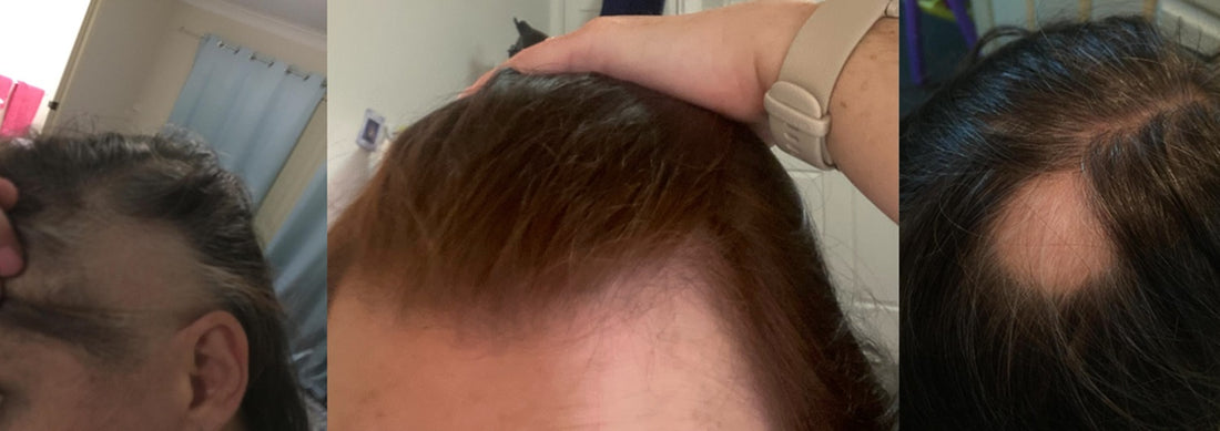 OMG Sharron's hair is growing back thanks to Zing Wellbeing!