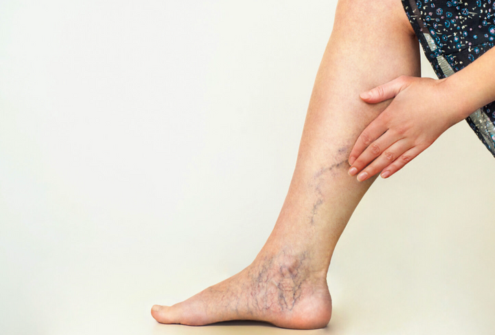 How to reduce varicose veins and improve circulation